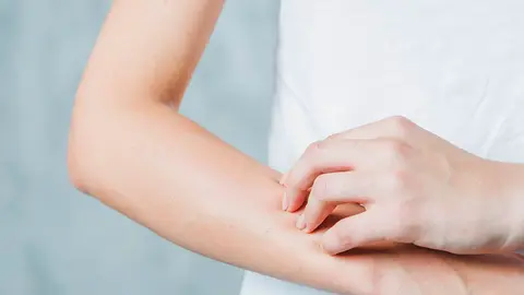  &iquest;Dermatitis at&oacute;pica en verano?: As&iacute; es c&oacute;mo puedes tratarla en casa. Foto freepik. 
